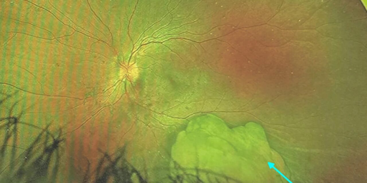 Optic Disc Melanocytoma: Jet-Black and (Almost Always) Benign