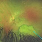 Optic disc melanocytoma: widefield fundus photograph showing a jet-black pigmented mass at the optic disc (arrow)