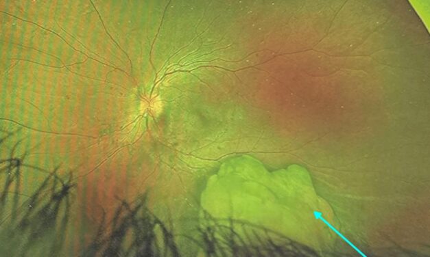 Optic Disc Melanocytoma: Jet-Black and (Almost Always) Benign
