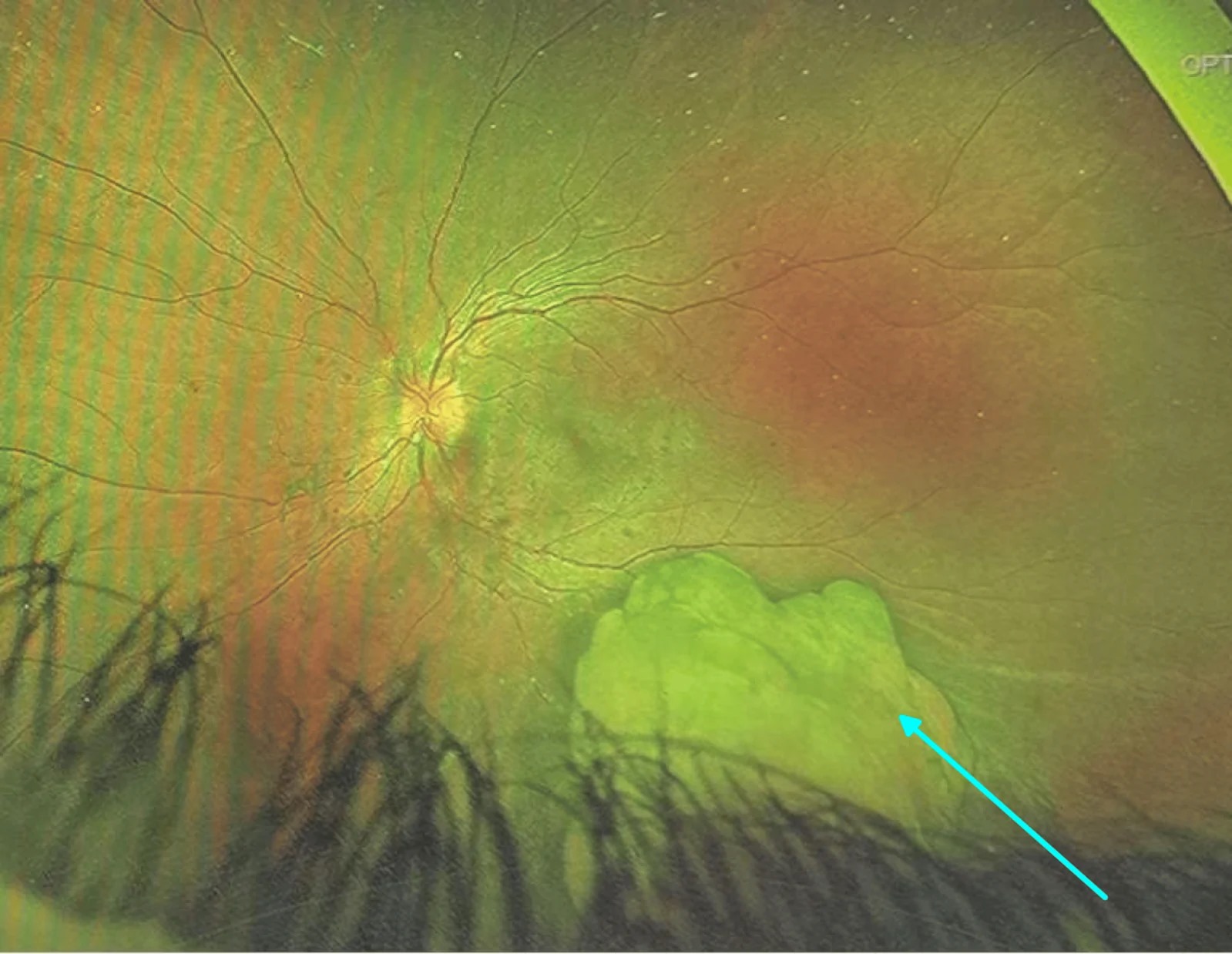 Optic Disc Melanocytoma Widefield Fundus Optic disc melanocytoma: widefield fundus photograph showing a jet-black pigmented mass at the optic disc (arrow)