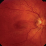 Clinical eye photograph illustrating Optic Disc Pit Maculopathy