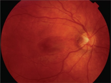 Optic Disc Pit Maculopathy: Fluid With No Retinal Break to Blame