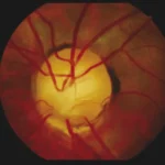 Optic Nerve Hypoplasia: clinical photograph