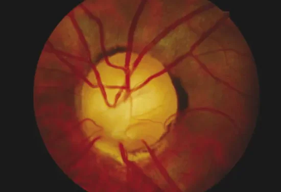 Optic Nerve Hypoplasia: The Small Disc That Calls for a Pituitary Workup