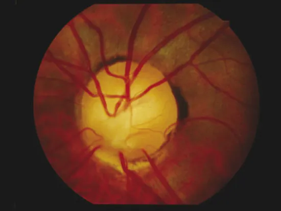 Optic Nerve Hypoplasia: The Small Disc That Calls for a Pituitary Workup
