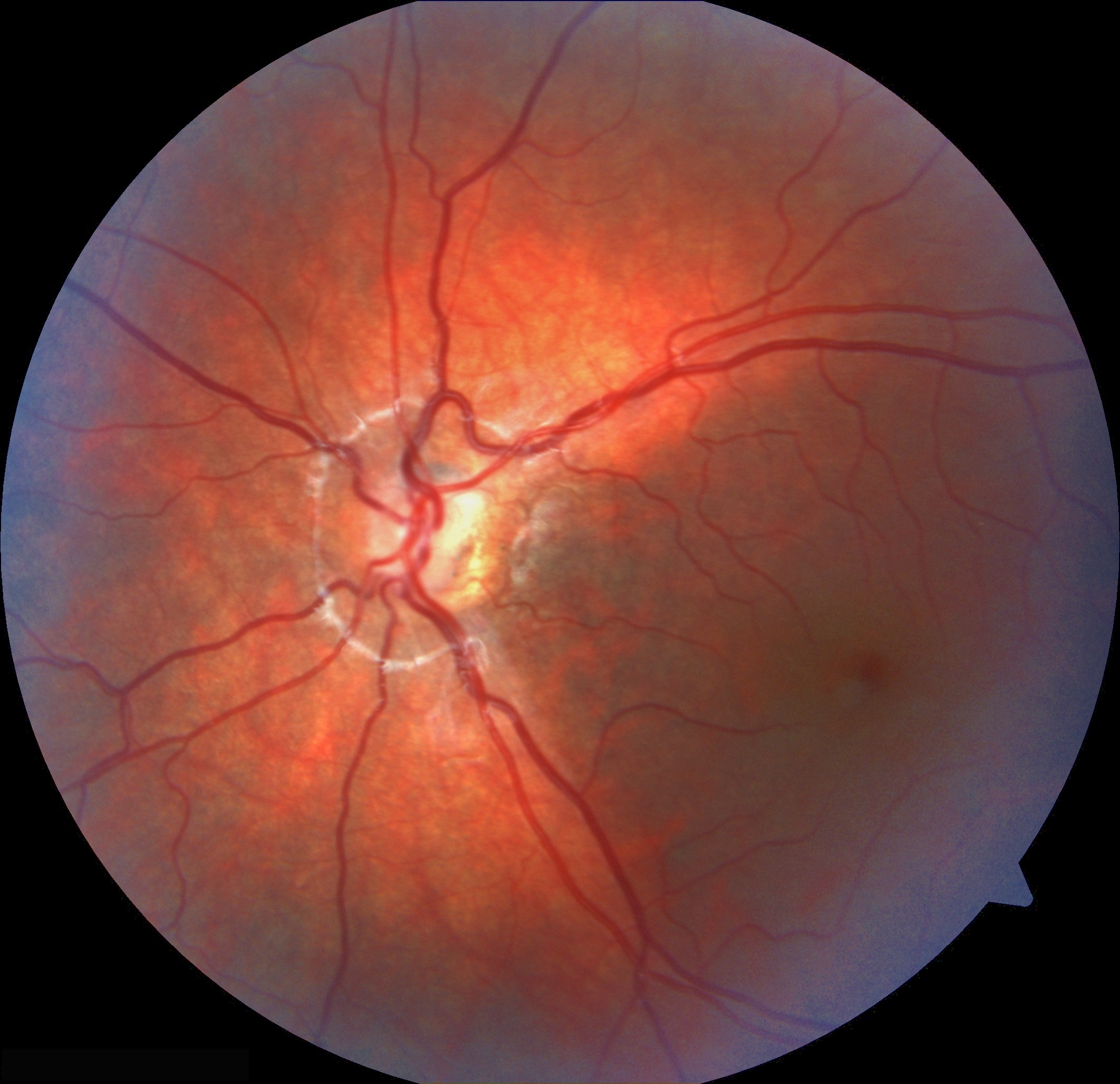 Optic Nerve Hypoplasia: clinical photograph, second view