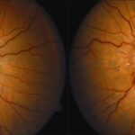 Optic Nerve Sheath Fenestration: clinical photograph