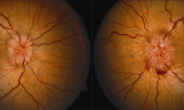 Optic Nerve Sheath Fenestration: Protecting Vision Without Diverting the CSF