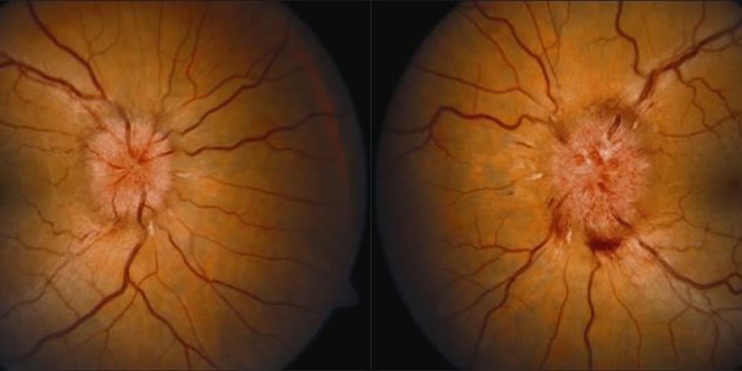 Optic Nerve Sheath Fenestration Clinical Photograph 1 Optic Nerve Sheath Fenestration: clinical photograph