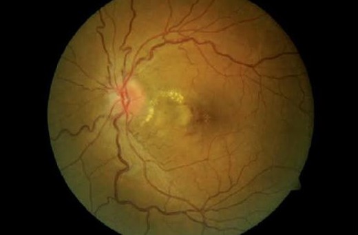 Optic Nerve Sheath Fenestration Clinical Photograph 2 Optic Nerve Sheath Fenestration: clinical photograph, second view