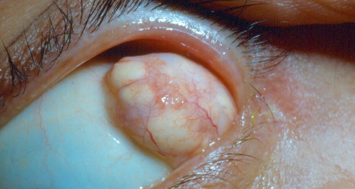 Orbital Dermoid Cyst: A Trapped Piece of Skin at the Suture Line