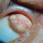Orbital Dermoid Cyst: clinical photograph