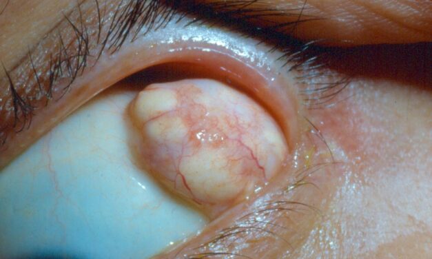 Orbital Dermoid Cyst: A Trapped Piece of Skin at the Suture Line