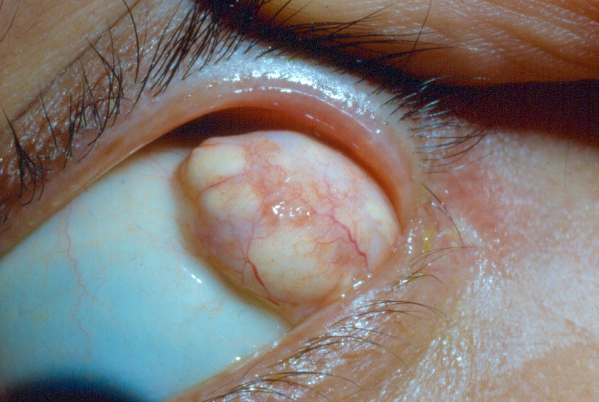 Orbital Dermoid Cyst Clinical Photograph 1 Orbital Dermoid Cyst: clinical photograph