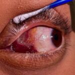 Orbital Lymphangioma: clinical photograph