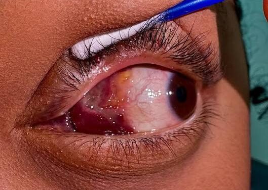 Orbital Lymphangioma: Stable Until It Suddenly Isn’t