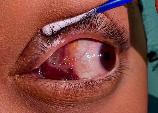 Orbital Lymphangioma Clinical Photograph 1 Orbital Lymphangioma: clinical photograph