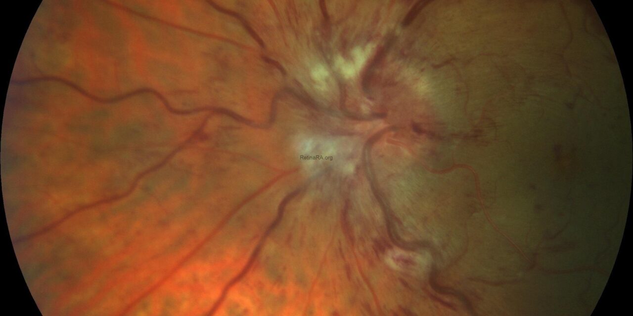 Papillophlebitis: The Young Patient’s Vein Occlusion Look-Alike