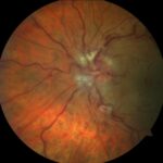 Papillophlebitis: fundus photograph