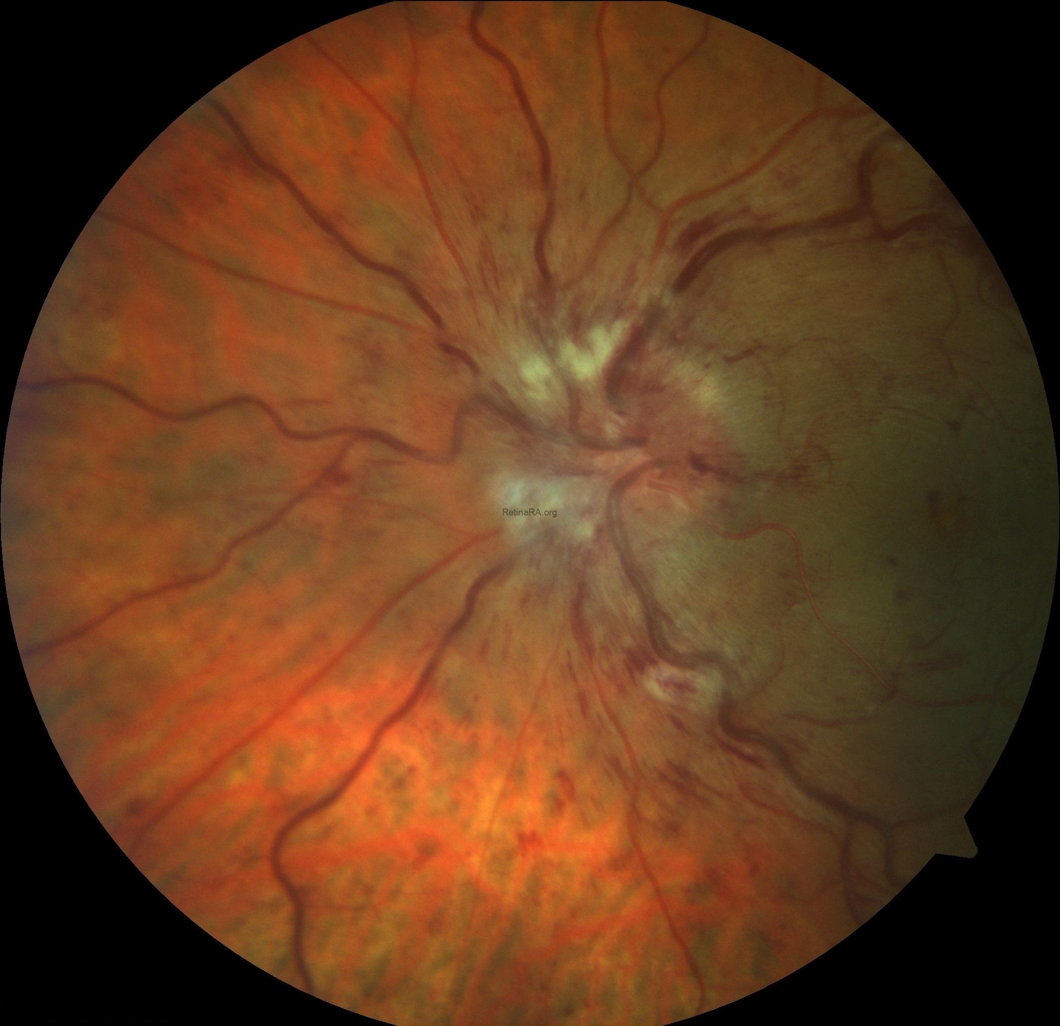 Papillophlebitis: fundus photograph