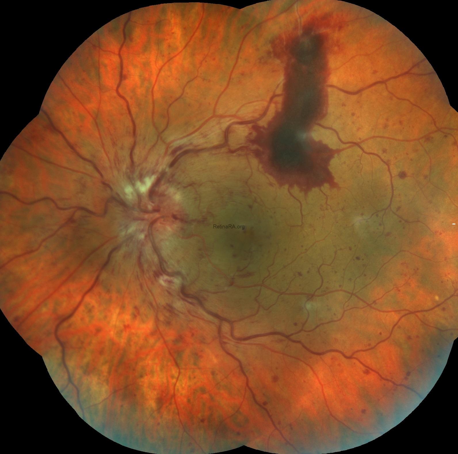 Papillophlebitis: fundus photograph, second view