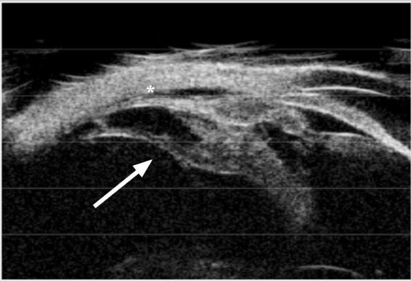Pars Planitis Ultrasound Biomicroscopy Pars planitis: ultrasound biomicroscopy showing a cyclitic membrane extending to the pars plana (arrow) with peripheral choroidal detachment (asterisk)