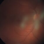 Pars planitis: fundus photograph showing vitreous haze and snowballs in a young patient
