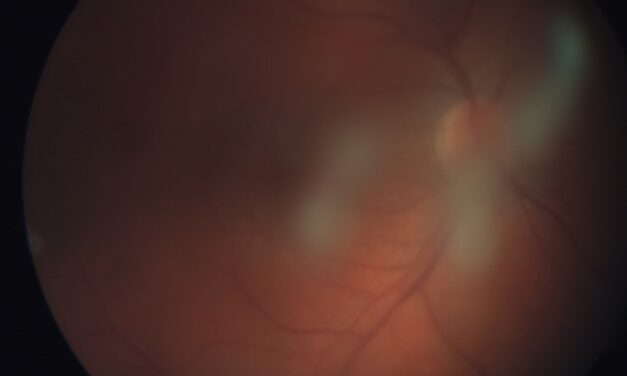Pars Planitis: The Intermediate Uveitis That Hides in Young Patients With Floaters