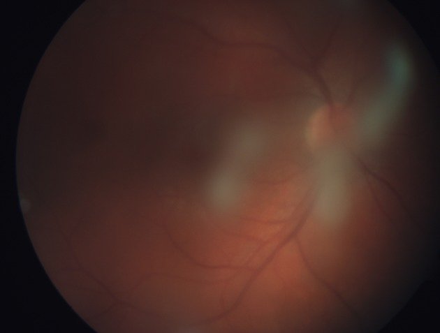Pars Planitis Vitreous Haze and Snowballs Pars planitis: fundus photograph showing vitreous haze and snowballs in a young patient