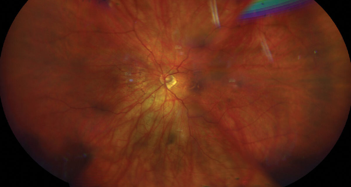 Pathologic Myopia: Grading Myopic Maculopathy With the META-PM Classification