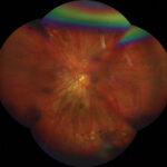Pathologic Myopia Meta Pm Classification: clinical photograph