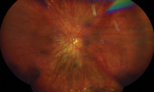 Pathologic Myopia: Grading Myopic Maculopathy With the META-PM Classification