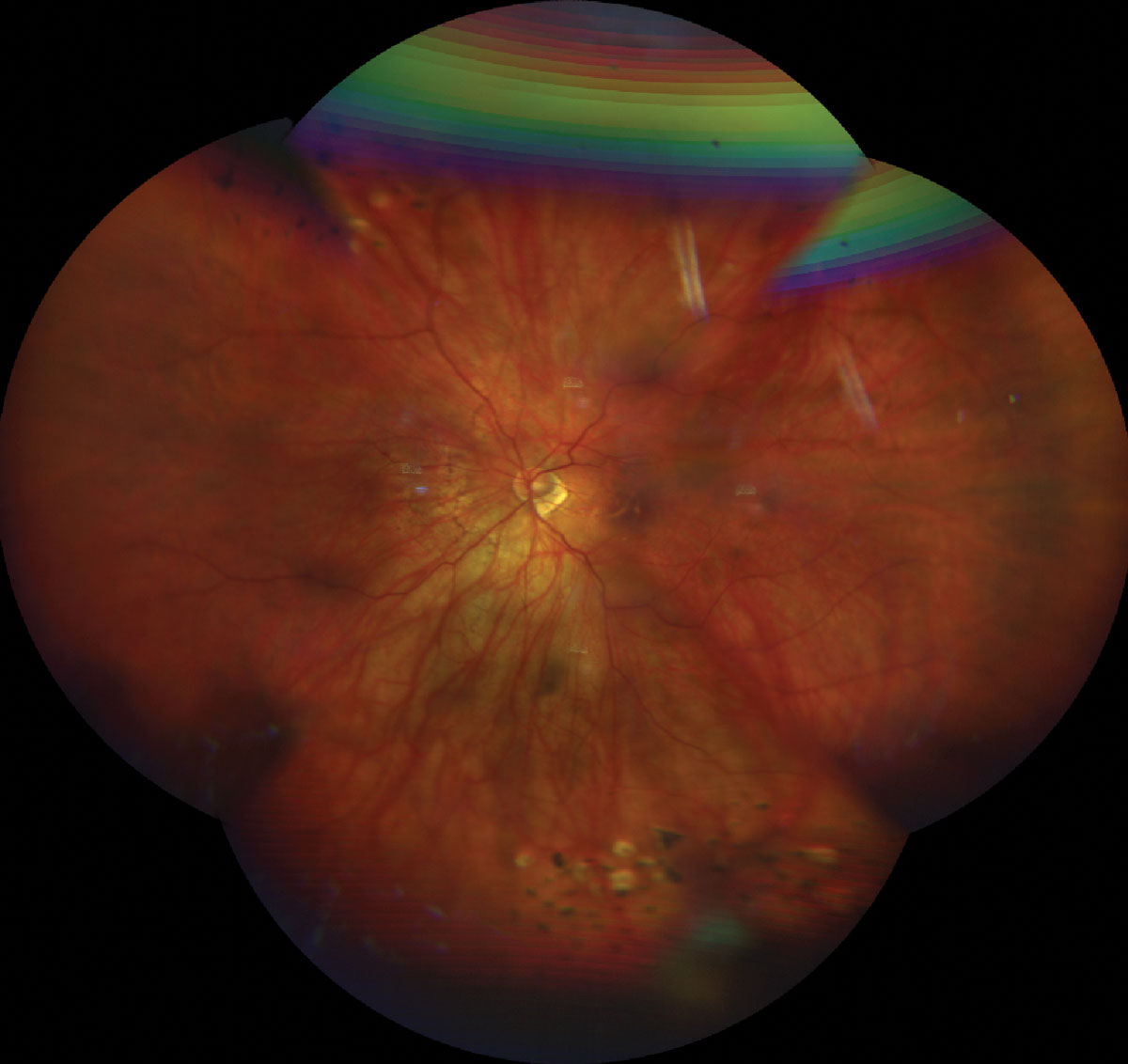 Pathologic Myopia Meta Pm Classification Clinical Photograph 1 Pathologic Myopia Meta Pm Classification: clinical photograph