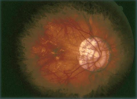 Pathologic Myopia Meta Pm Classification Clinical Photograph 2 Pathologic Myopia Meta Pm Classification: clinical photograph, second view
