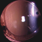 Clinical eye photograph illustrating Pediatric Cataract Surgery Iol Timing