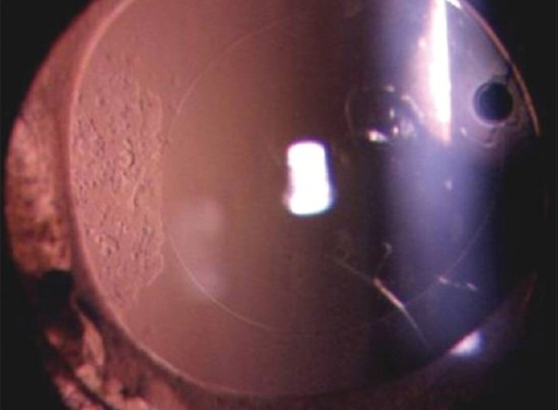 Pediatric Cataract Surgery: Deciding When to Implant a Lens