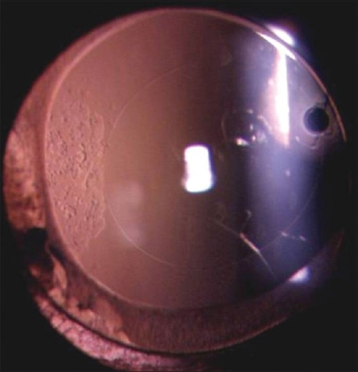 Pediatric Cataract Surgery: Deciding When to Implant a Lens