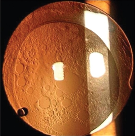 Clinical eye photograph illustrating Pediatric Cataract Surgery Iol Timing