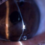 Clinical eye photograph illustrating Pellucid Marginal Degeneration vs Keratoconus