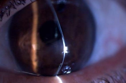 Pellucid Marginal Degeneration Versus Keratoconus: Two Ectasias, Two Different Ablation Maps