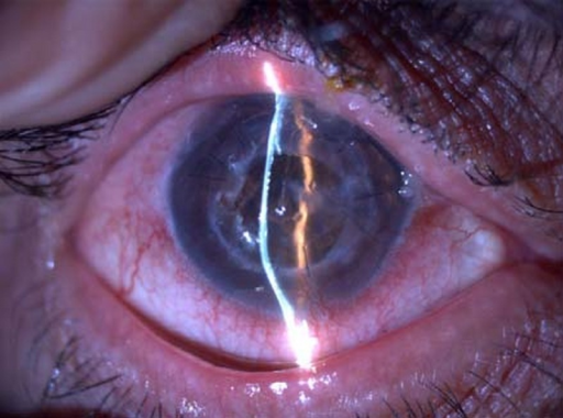 Clinical eye photograph illustrating Pellucid Marginal Degeneration vs Keratoconus