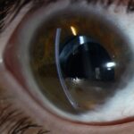 Perfluorocarbon Liquids Vitreoretinal Surgery: clinical photograph