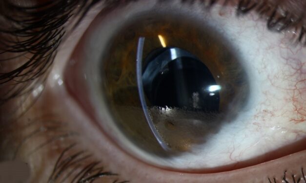 Perfluorocarbon Liquids: The Heavy Tool That Flattens the Retina Mid-Surgery
