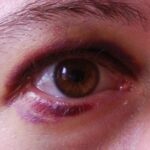 Periorbital ecchymosis (black eye): bruising and swelling of the eyelid and periorbital skin after blunt trauma