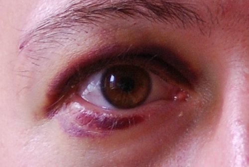 Periorbital Ecchymosis: Simple Bruise or Skull Fracture Sign?