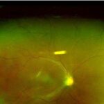 Peripheral retinal variants: ultra-widefield fundus image of a right eye with a peripheral vitreoretinal interface lesion