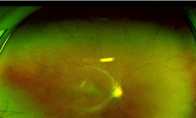 Peripheral Retinal Variants That Mimic Pathology: A Guide for Residents