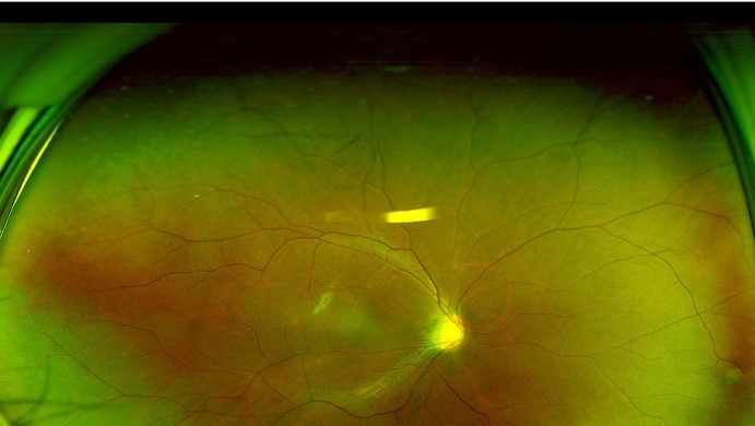 Peripheral Retinal Variants That Mimic Pathology: A Guide for Residents
