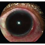 Peripheral ulcerative keratitis: eye with a peripheral corneal ulcer extending along the limbus with adjacent conjunctival injection
