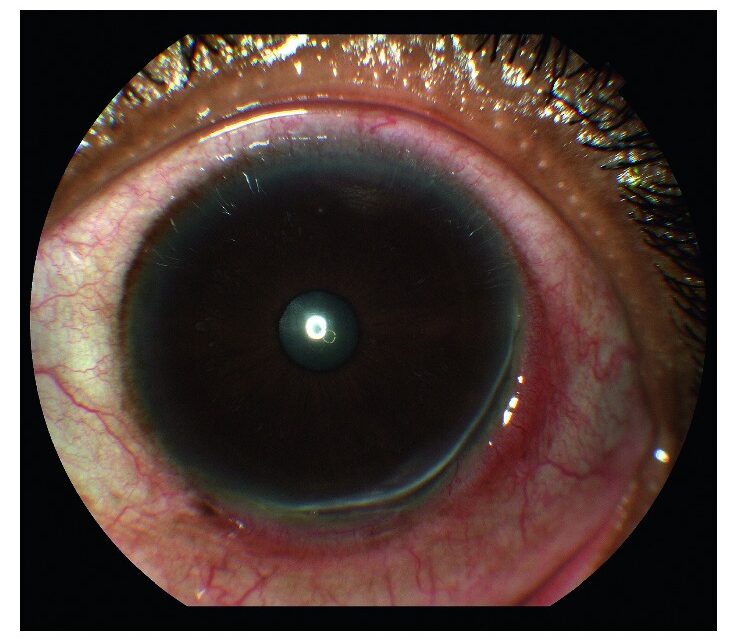 Peripheral Ulcerative Keratitis: A Corneal Sign of Systemic Vasculitis